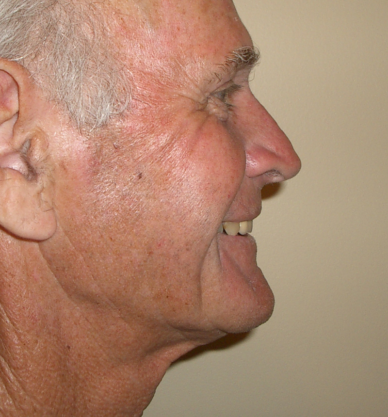 neck lift after right profile view