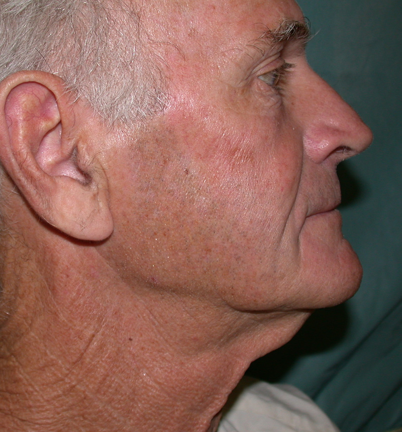 neck lift before right profile view