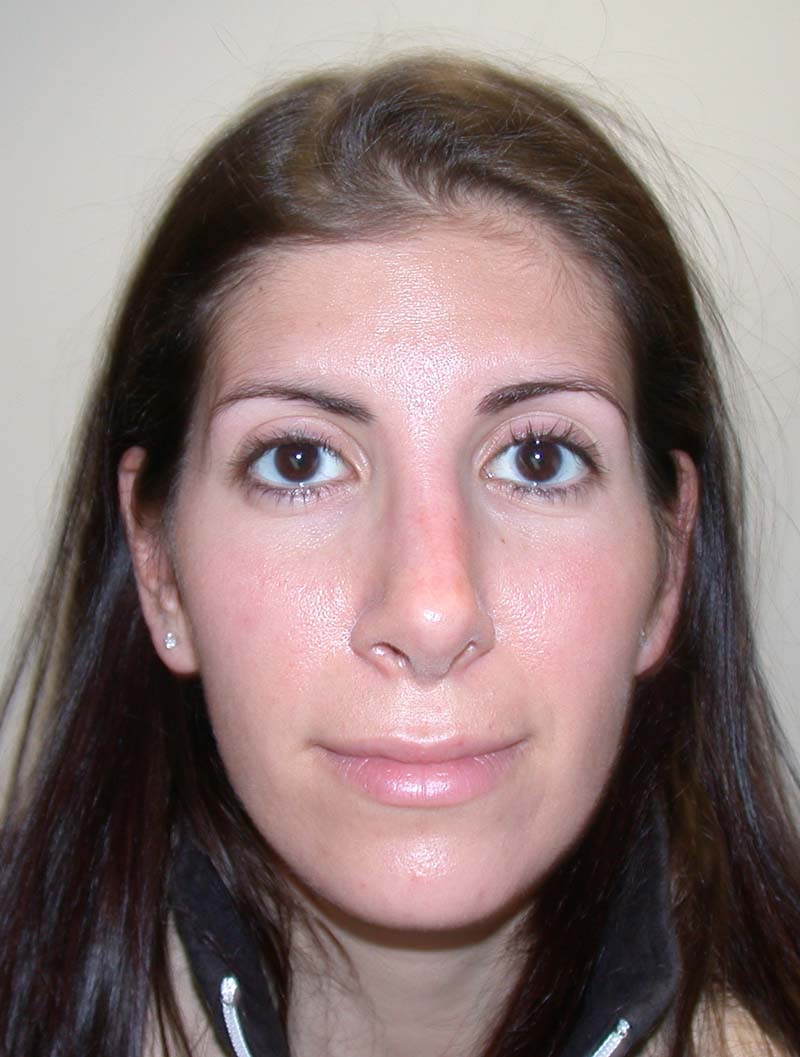after revision rhinoplasty front view