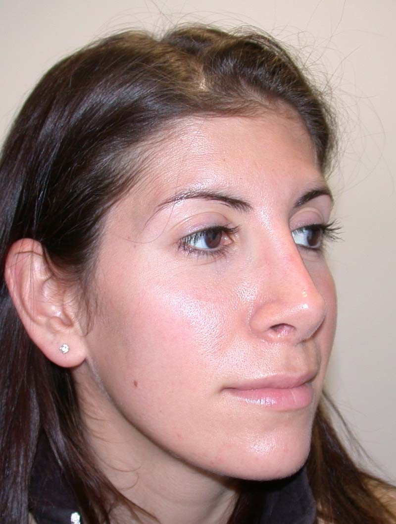 after revision rhinoplasty right oblique angle view