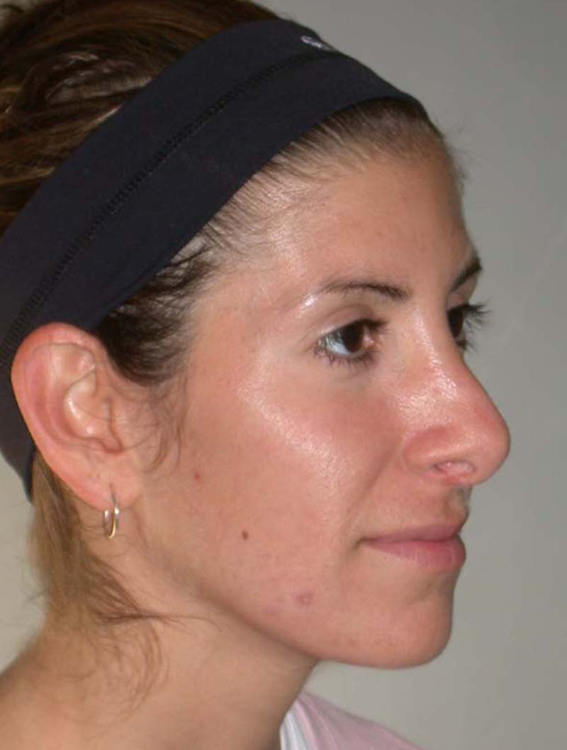 before revision rhinoplasty right profile
