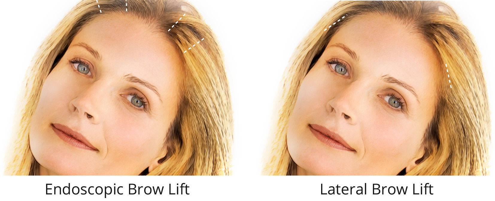 endoscopic lateral brow lift diagrams