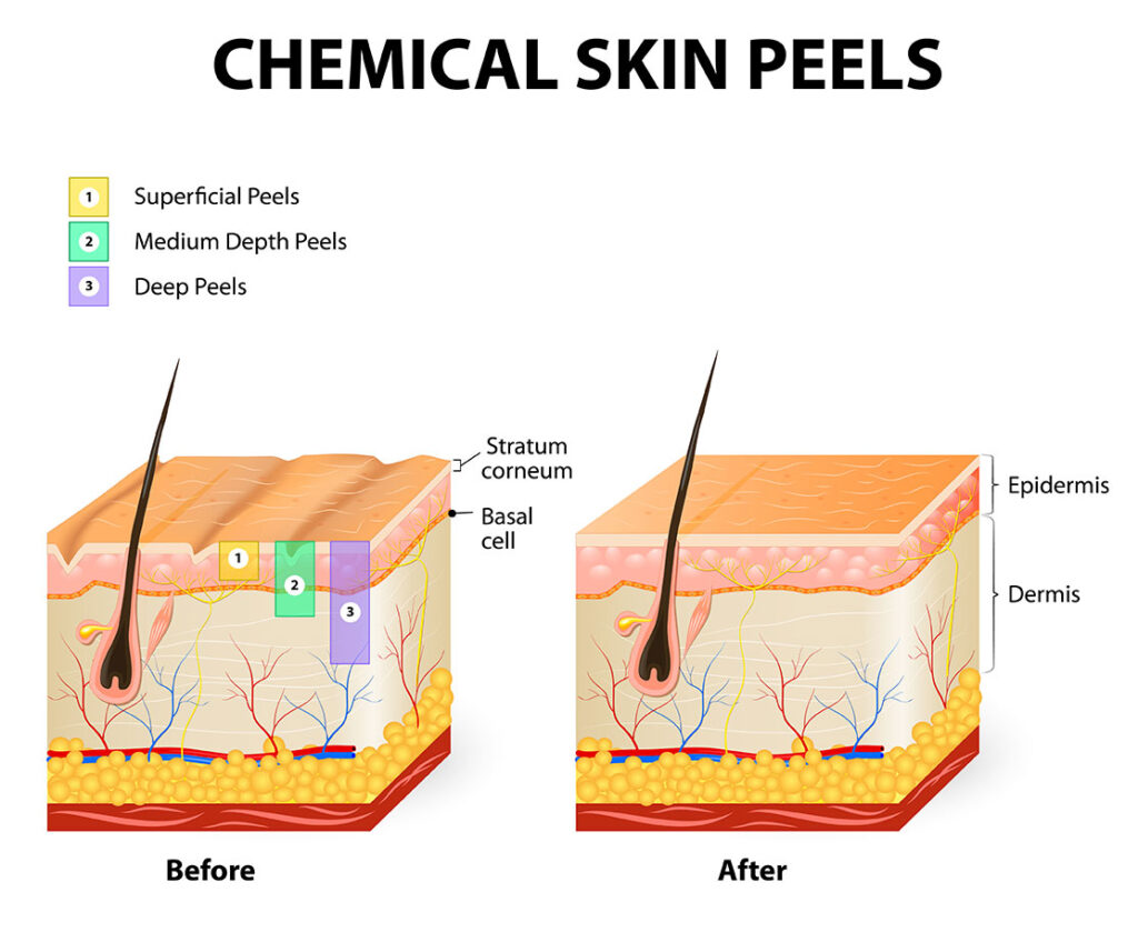 Chemical Peels diagram