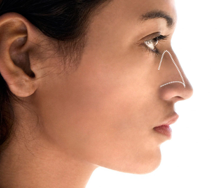 female rhinoplasty diagram