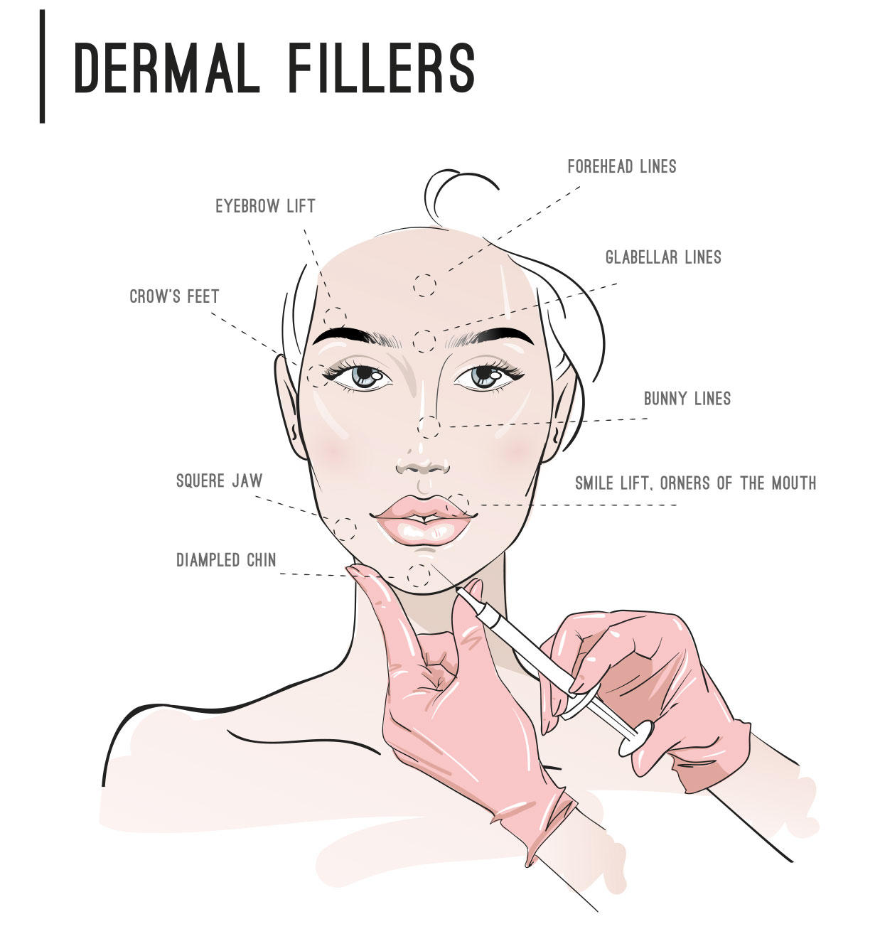 dermal fillers placement diagram