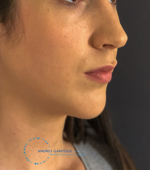 Toronto chin implant after right oblique angle view