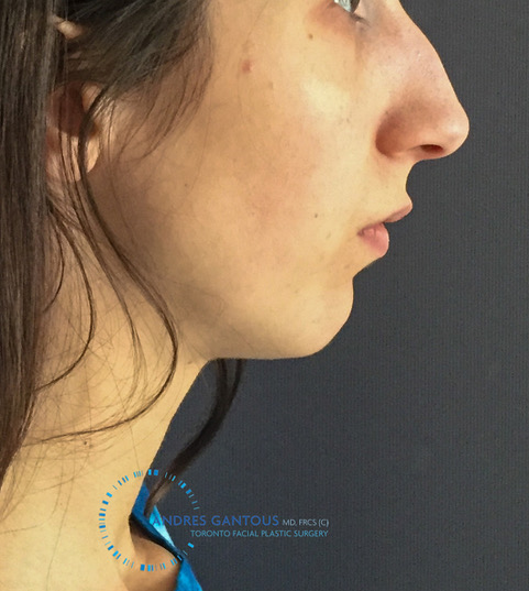 Toronto chin implant before right profile view