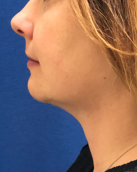 Neck Liposuction After