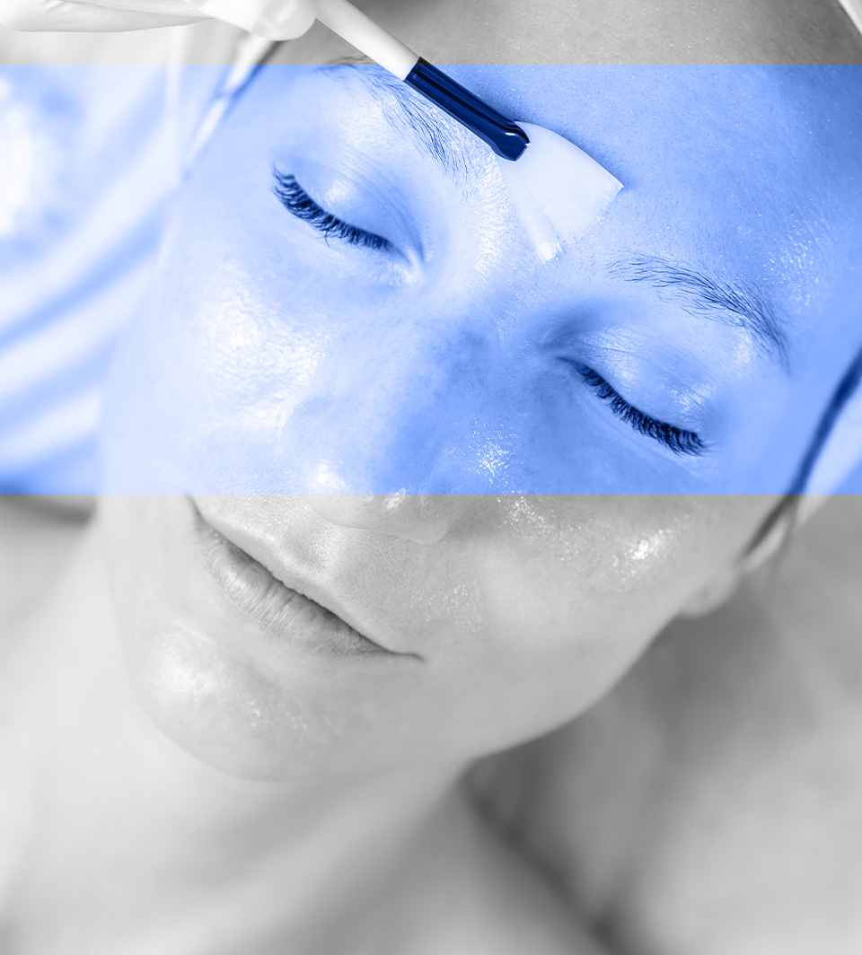 chemical peel treatment in Toronto