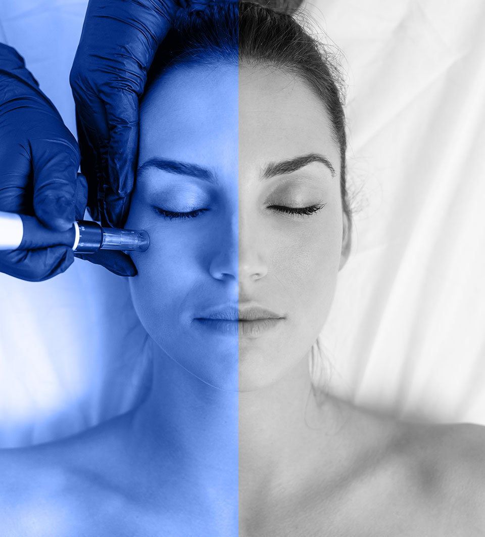 model receiving prp treatment in toronto